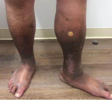 Healed venous leg ulcer after OCM treatment