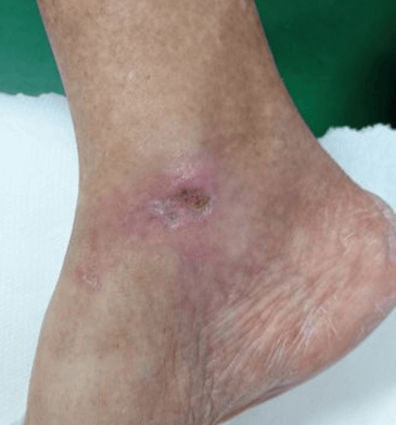 Healed diabetic foot ulcer after OCM treatment