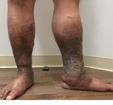 Chronic venous leg ulcer before OCM treatment